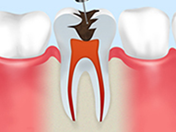 虫歯菌に冒された歯髄の除去