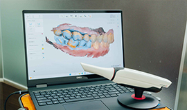 型採りの不快感をゼロに「口腔内スキャナー」