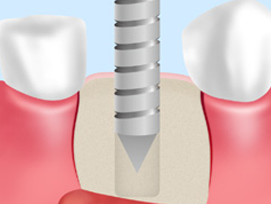 抜歯即時埋入法