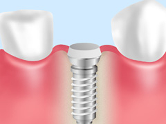 抜歯即時埋入法
