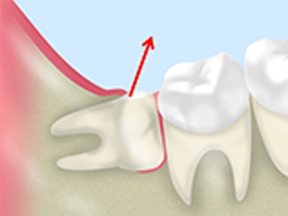 親知らずで抜けた歯の機能を回復できる