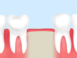 親知らずで抜けた歯の機能を回復できる