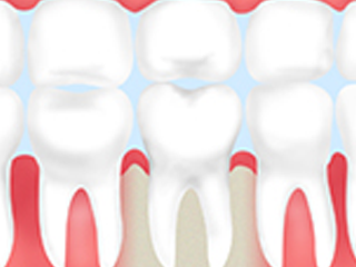 親知らずで抜けた歯の機能を回復できる