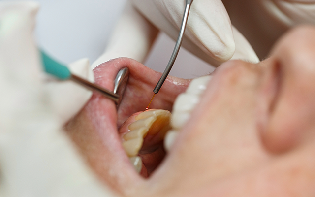 歯科用のレーザーを用いた痛みの少ない治療