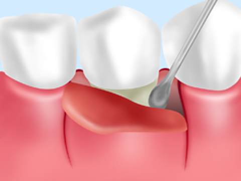 歯周ポケット掻爬（そうは）術